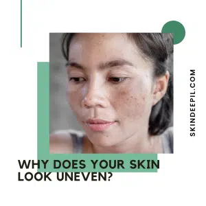 uneven skin tone, hyperpigmentation, melasma