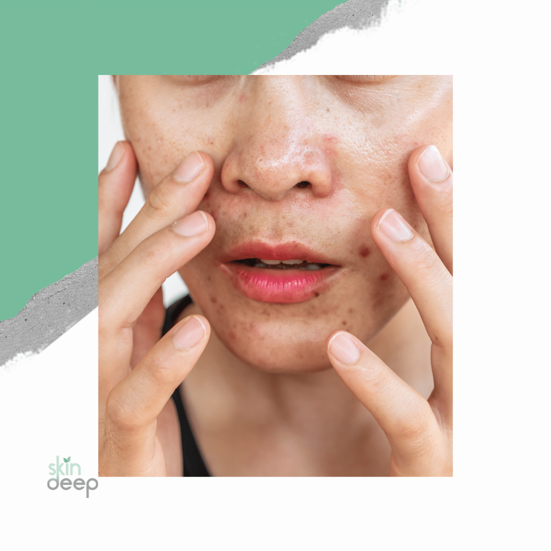 ultimate skincare routine for oily skin