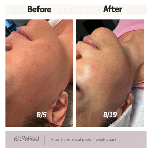 Before and After 3 BioRePeel treatments spaced out once a week