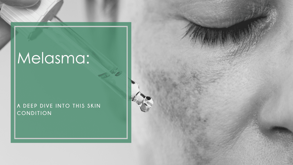 Melasma: A common condition - discover the causes, types, and treatments. Learn how to manage triggers and lighten dark patches