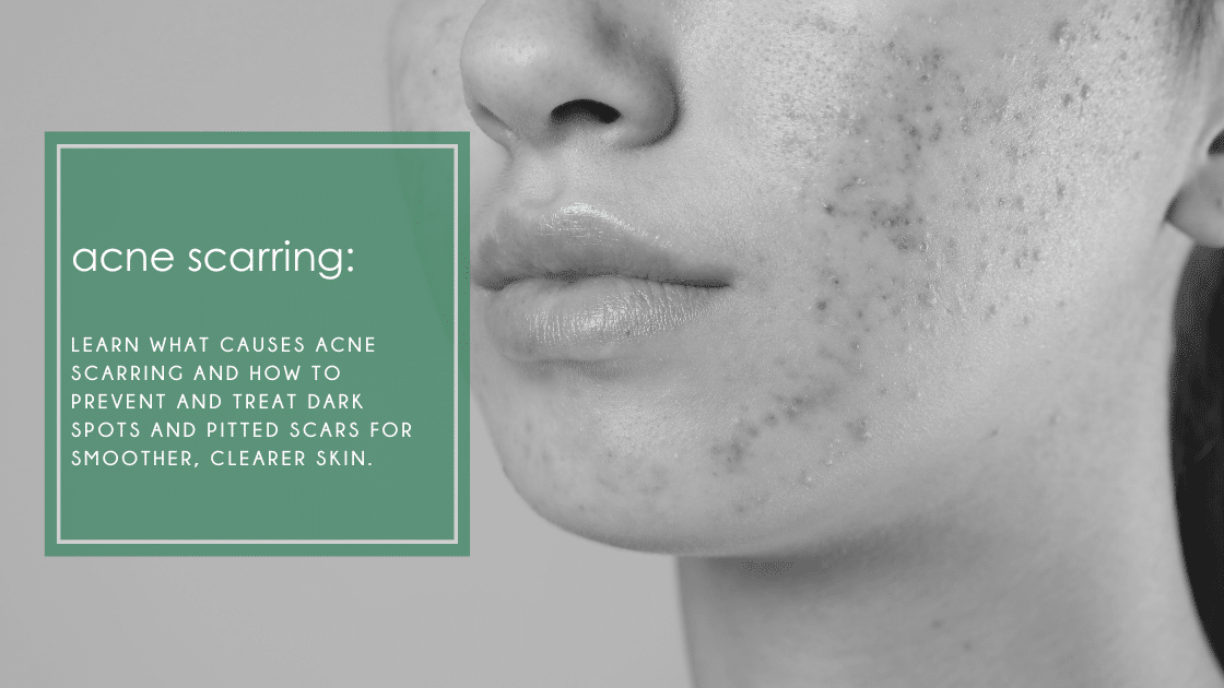 Acne scarring: Learn what causes acne scarring and how to prevent and treat scars for smoother, clearer skin.
