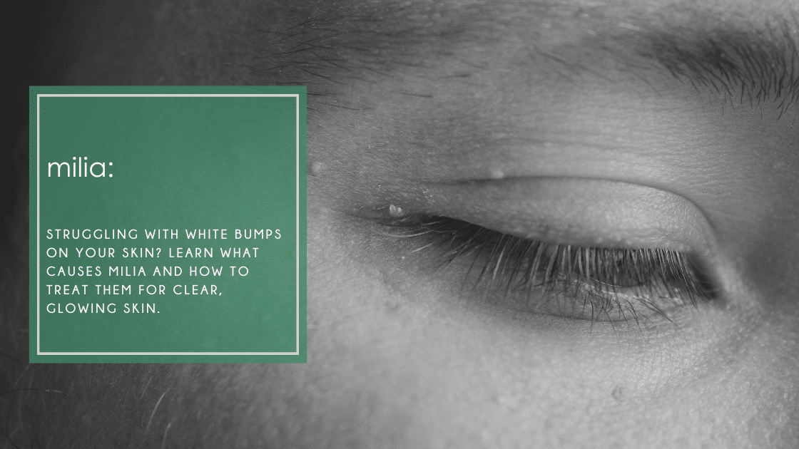 Milia: Struggling with white bumps on your skin? Learn what causes milia and how to treat them for clear, glowing skin.
