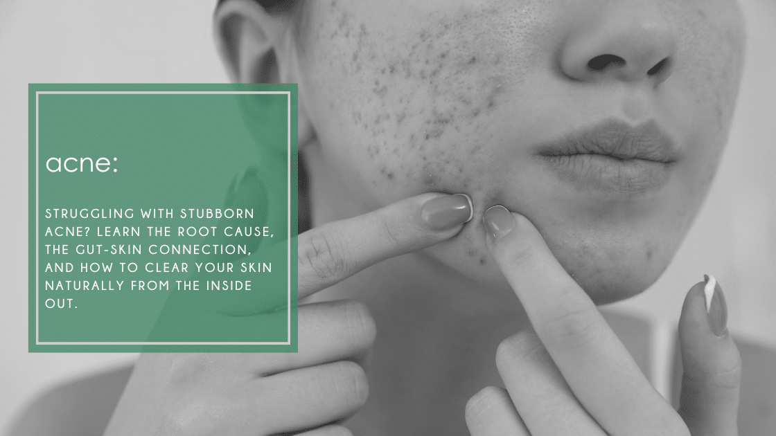 Struggling with stubborn acne? Learn the root cause, the gut-skin connection, and how to clear your skin naturally from the inside out.