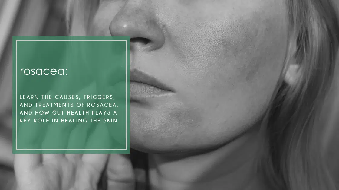 Learn the causes, triggers, and treatments of rosacea, and how gut health plays a key role in healing the skin.